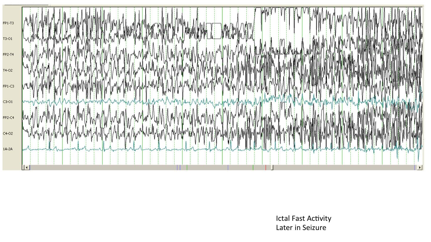 electroencephalogram (EEG)