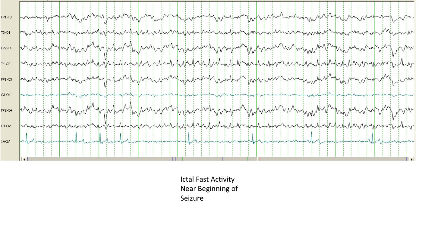 electroencephalogram (EEG)