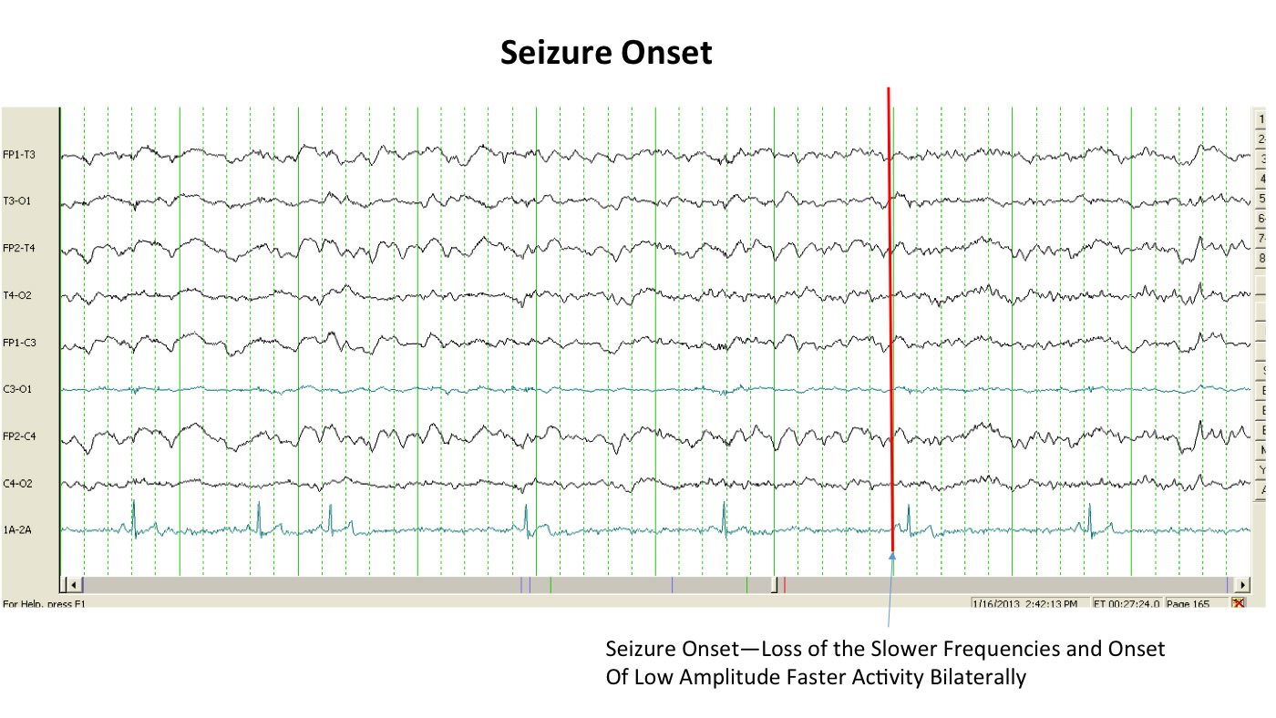 electroencephalogram (EEG)